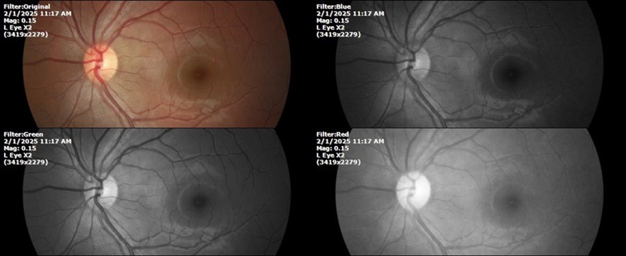 The photograph of the fundus, on the left side, remains unaltered.