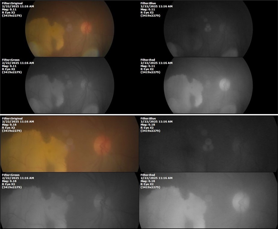 The whitish mass of phantom cells continues to decrease. The treatment continues to be based on ǪIAPI 1®, sublingual drops, three drops every hour, for as long as the patient is awake.